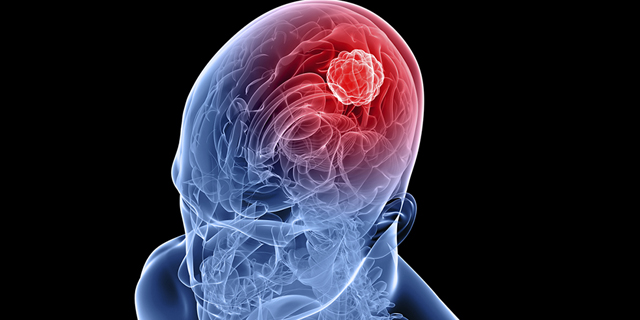 Pakai Ponsel 6 Jam, Pria Ini kena Kanker Otak