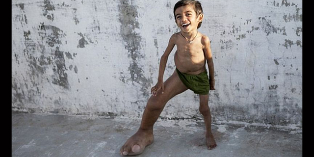 Astaga, Kaki Bocah Ini Beratnya Mencapai 5,4 Kg